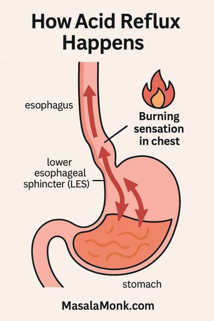 Medical infographic showing how acid reflux happens, with stomach acid moving upward through a weak lower esophageal sphincter (LES) into the esophagus, causing burning sensation in the chest. MasalaMonk.com branding at bottom.